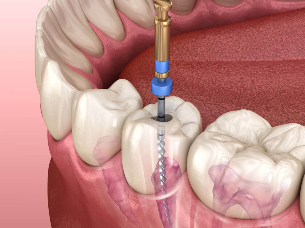 What To Expect From Root Canal Treatment