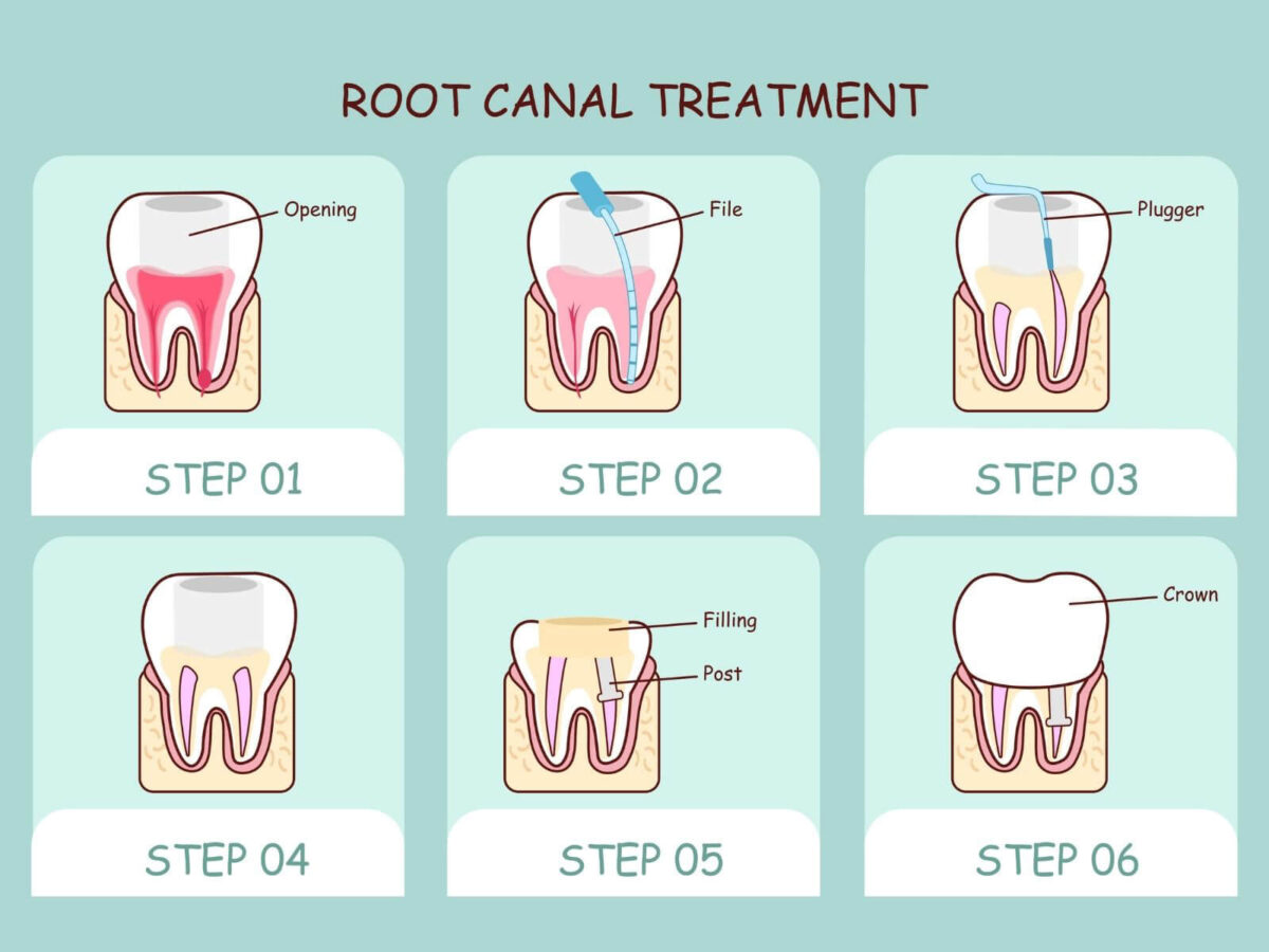 Signs You Might Need A Root Canal Treatment
