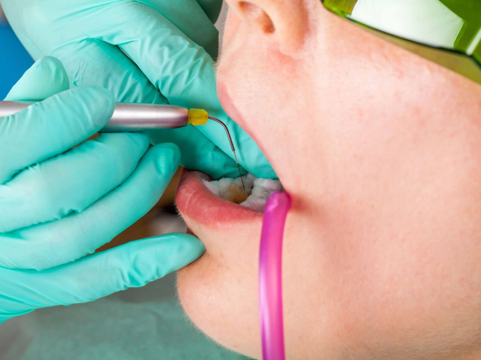 Laser Dentistry: Benefits, Uses & How It Works?