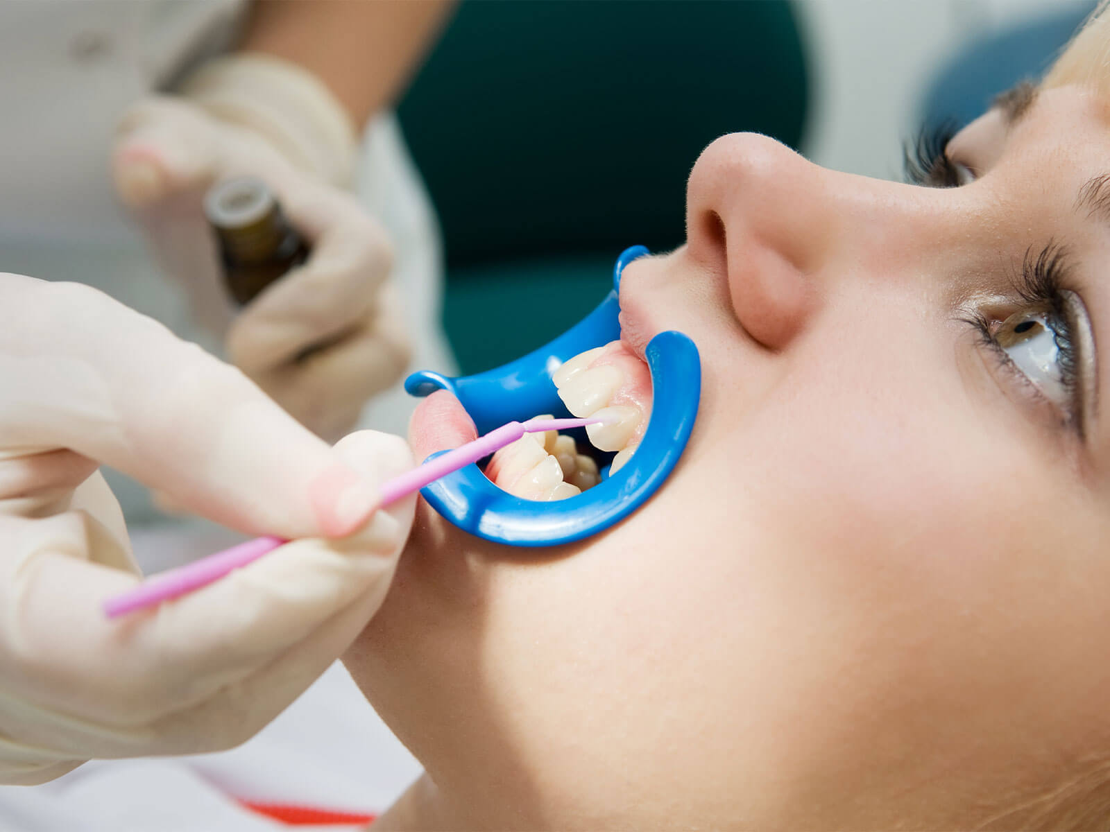 Pros and Cons of Dental Sealants