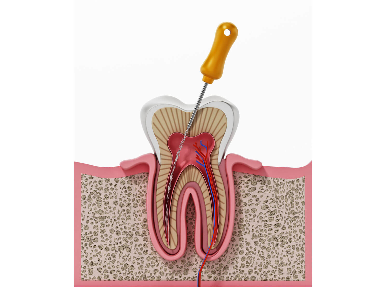 Root Canal Infection: Symptoms, Causes, and Treatment Options
