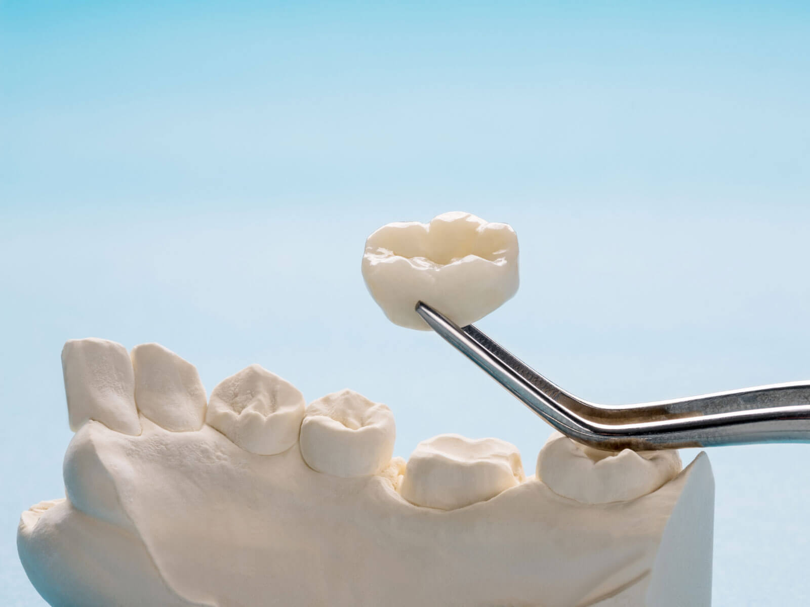 What Goes Into the Cost of a Dental Crown? A Transparent Breakdown