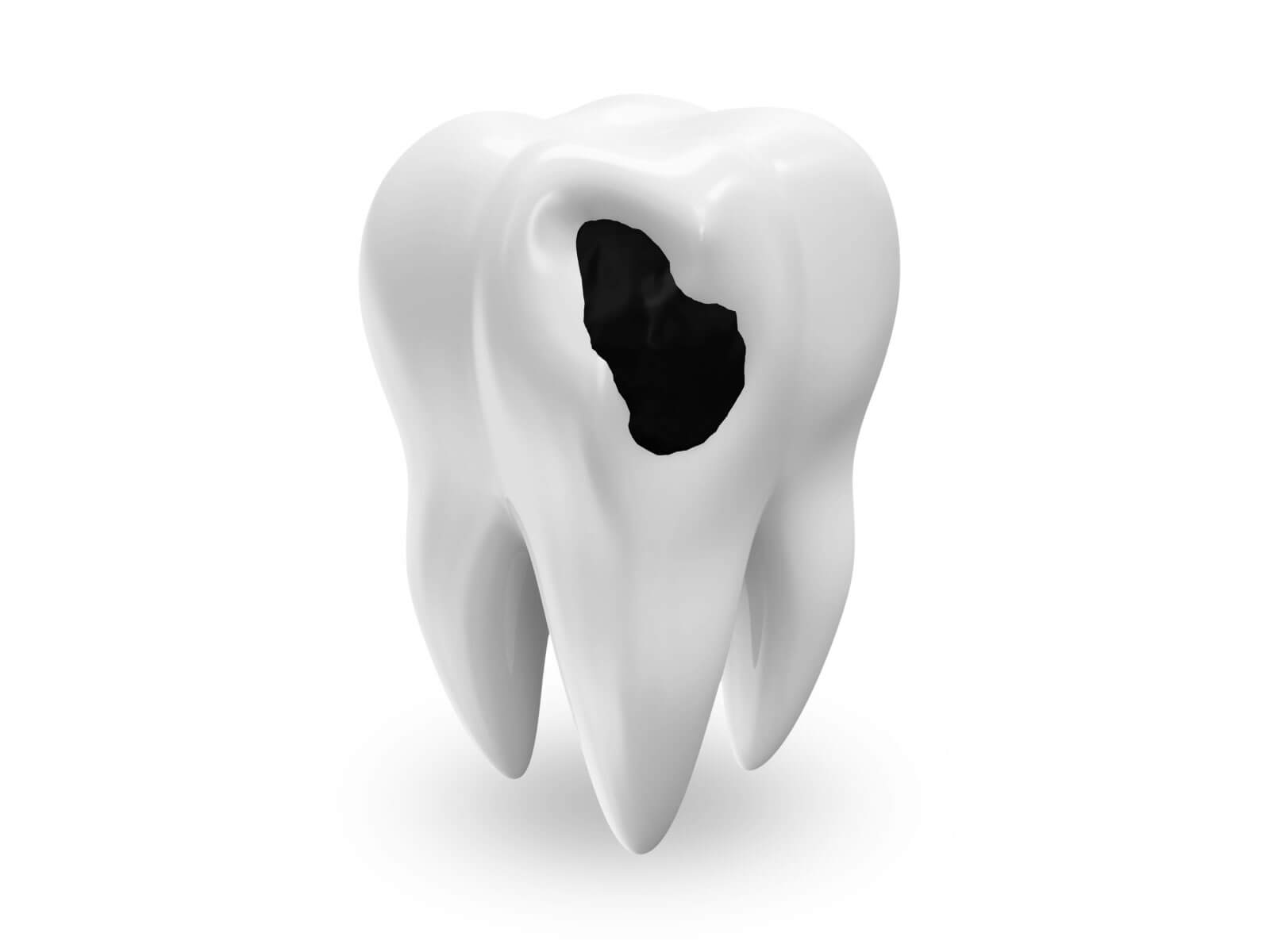 Black Dot on a Tooth: Common Causes and When It’s Something to Worry About